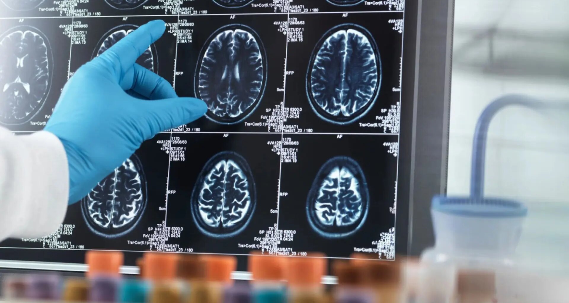 Un nuevo tratamiento con implantes cerebrales está revolucionando el tratamiento del párkinson