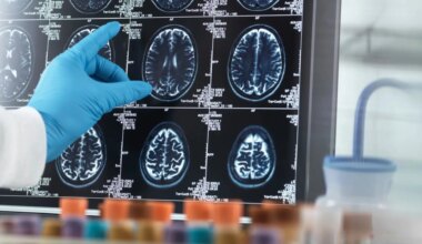 Un nuevo tratamiento con implantes cerebrales está revolucionando el tratamiento del párkinson