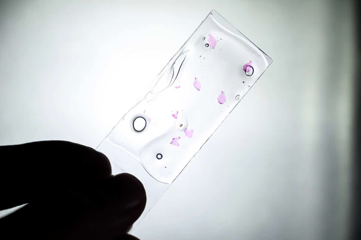 Hallan una nueva vía terapéutica en la lucha contra el cáncer hepático más agresivo