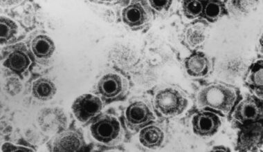 Descubren un antiviral contra el herpes que vence la resistencia a las curas actuales