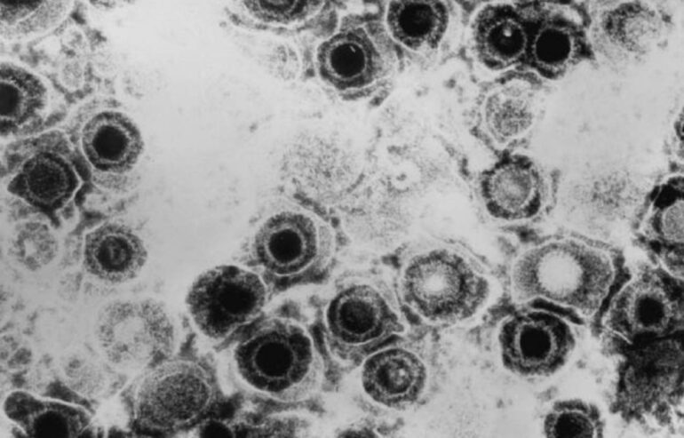 Descubren un antiviral contra el herpes que vence la resistencia a las curas actuales