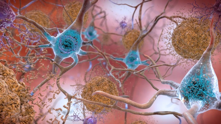 El alzhéimer, ¿una enfermedad infecciosa?