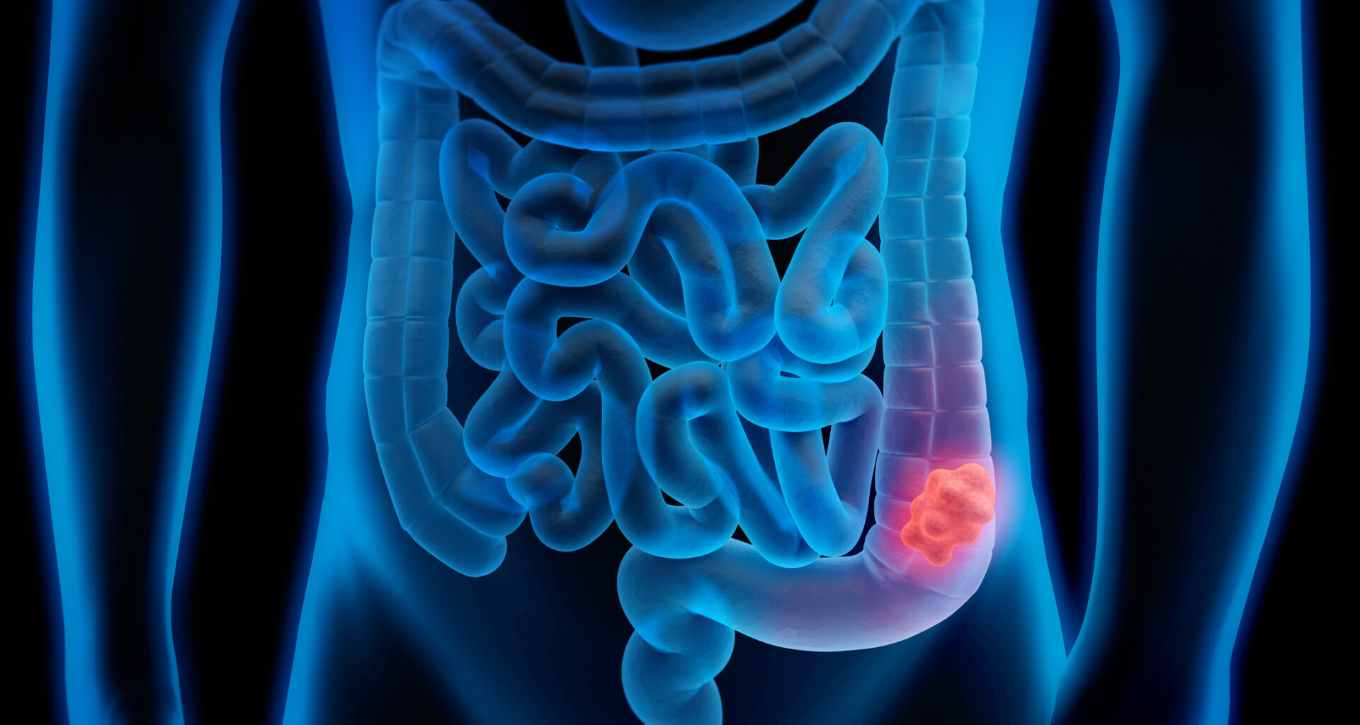 Un nuevo modelo matemático permite mejorar la detección de cáncer colorrectal