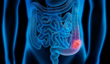 Un nuevo modelo matemático permite mejorar la detección de cáncer colorrectal