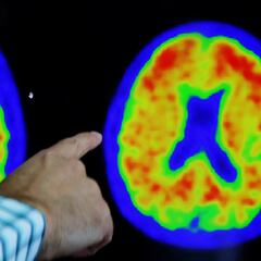 Un hombre explica el drama de ser diagnosticado de Alzheimer a los 41 años: “Una niebla se apodera de tu cerebro”
