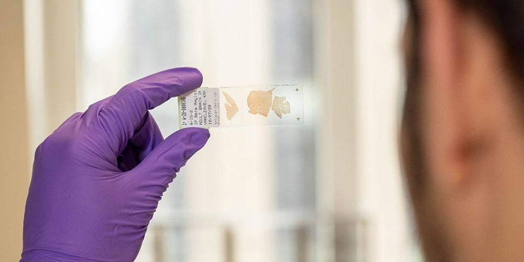 Un único fármaco podría ser una terapia casi universal para una enfermedad rara