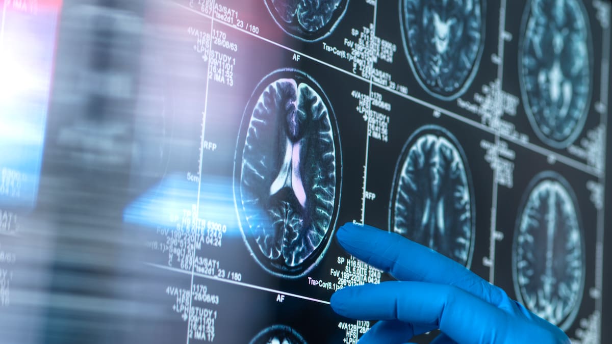 "Es un hito histórico": los dos grandes avances contra el alzhéimer que abren una nueva era de la lucha contra la enfermedad | Ciencia y tecnología