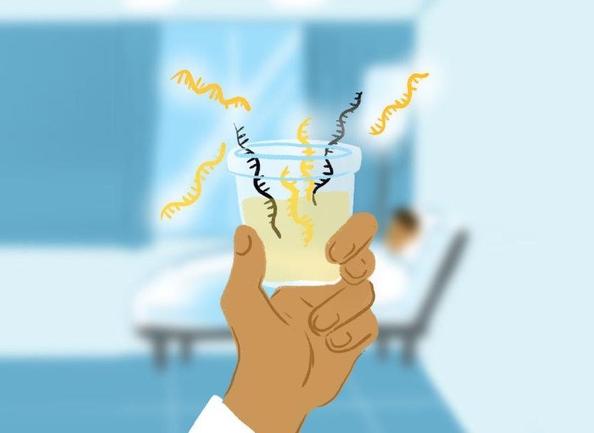 Nueva prueba de orina detecta cáncer de próstata - diagnostico-molecular