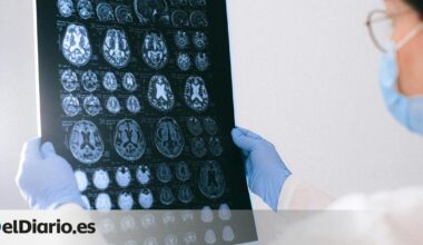 Pacientes con la enfermedad de Huntington son tratados por primera vez con éxito mediante terapia génica