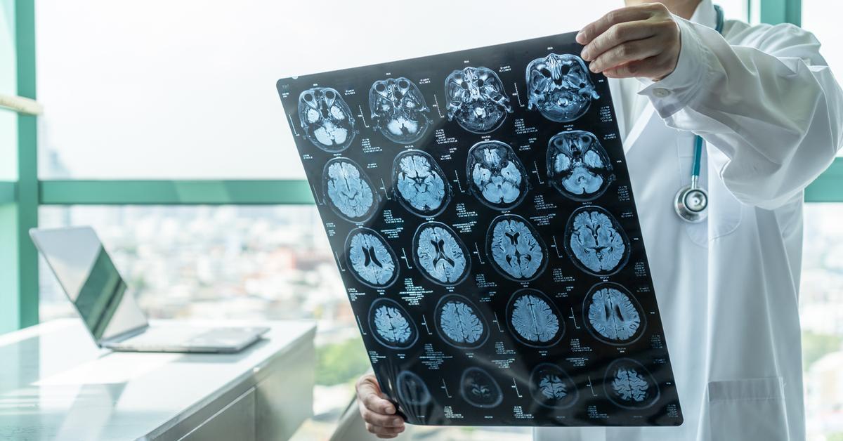 ¿Es posible regenerar el cerebro con células madre después de un ictus?