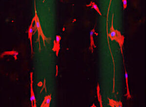 La durotaxis, clave en la metástasis del cáncer de páncreas