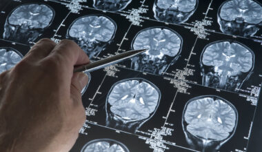Un neurólogo destaca que "en breve" llegarán a España nuevos medicamentos contra el Alzheimer que actúan sobre su origen