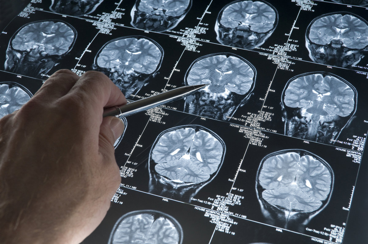 Un neurólogo destaca que "en breve" llegarán a España nuevos medicamentos contra el Alzheimer que actúan sobre su origen
