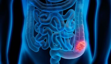 Un modelo matemático para detectar el cáncer colorrectal