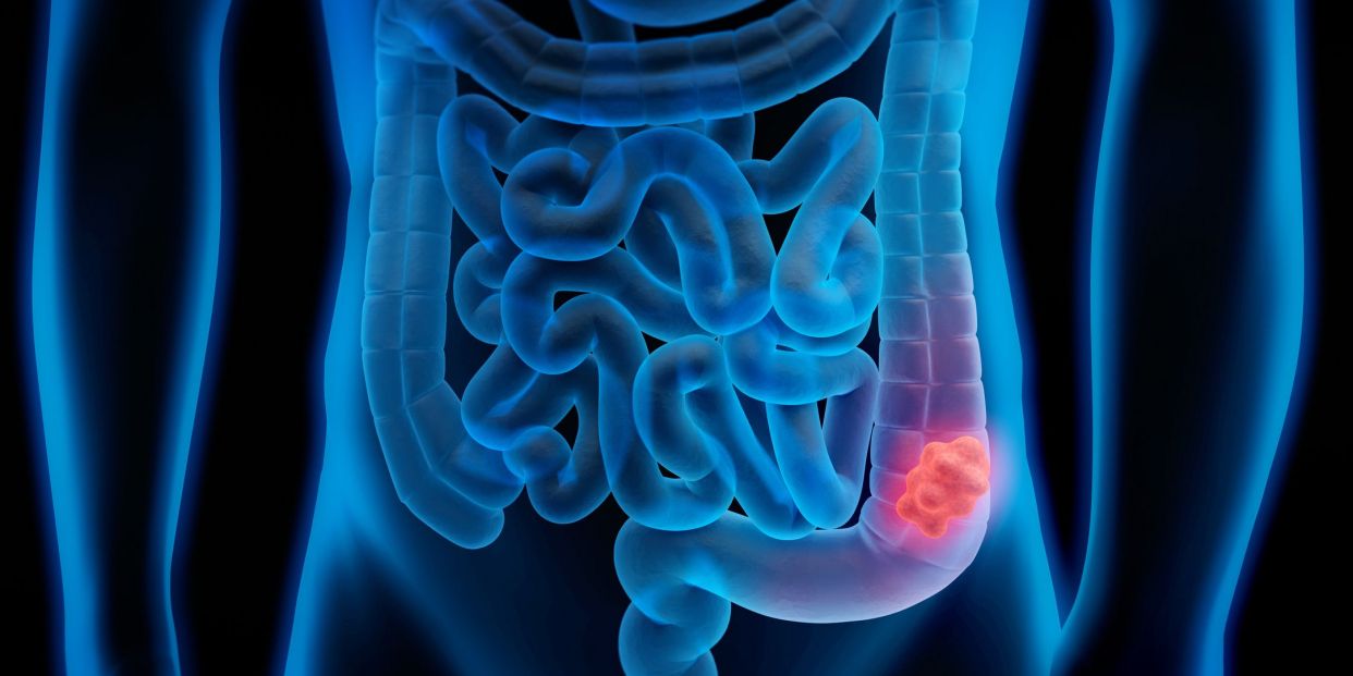 Un modelo matemático para detectar el cáncer colorrectal