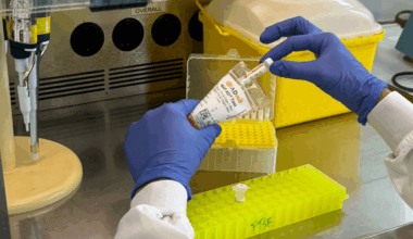 Bellvitge valida un biomarcador en sangre capaz de anticipar la progresión del alzhéimer