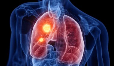 La terapia con icotinib ofrece beneficio en el cáncer de pulmón con mutaciones en el EGFR
