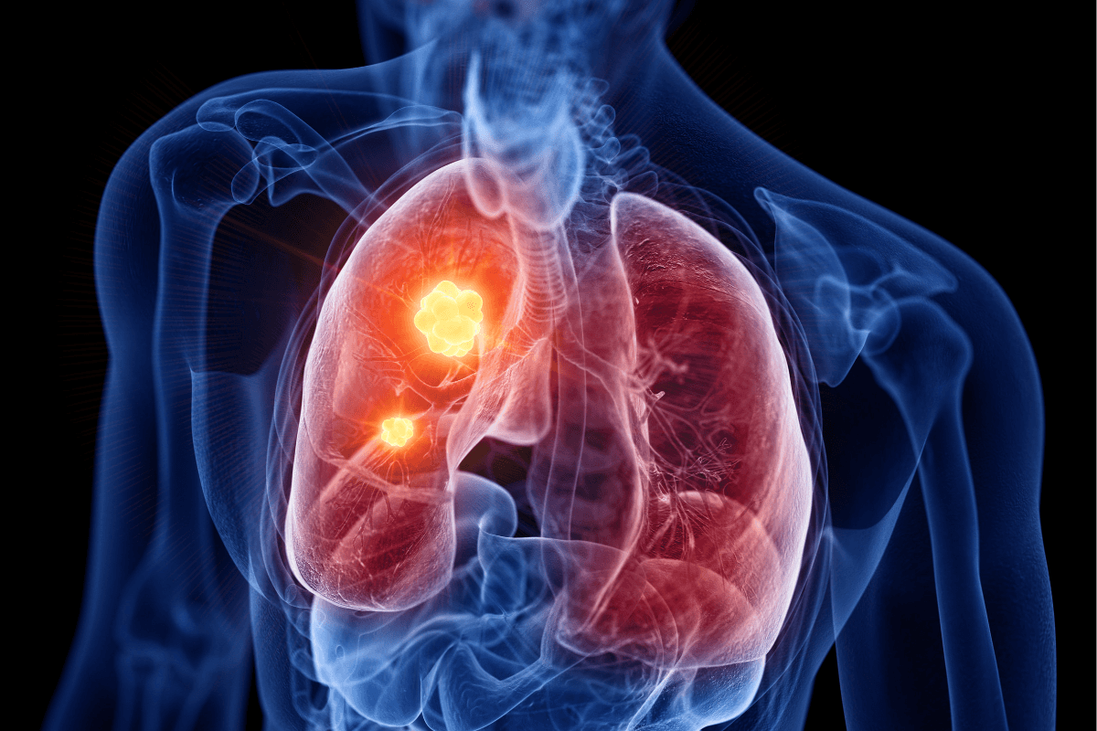 La terapia con icotinib ofrece beneficio en el cáncer de pulmón con mutaciones en el EGFR