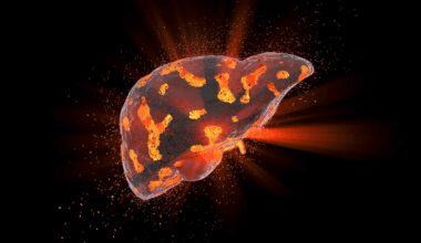 Setanaxib muestra actividad en modelos preclínicos de colangiocarcinoma intrahepático