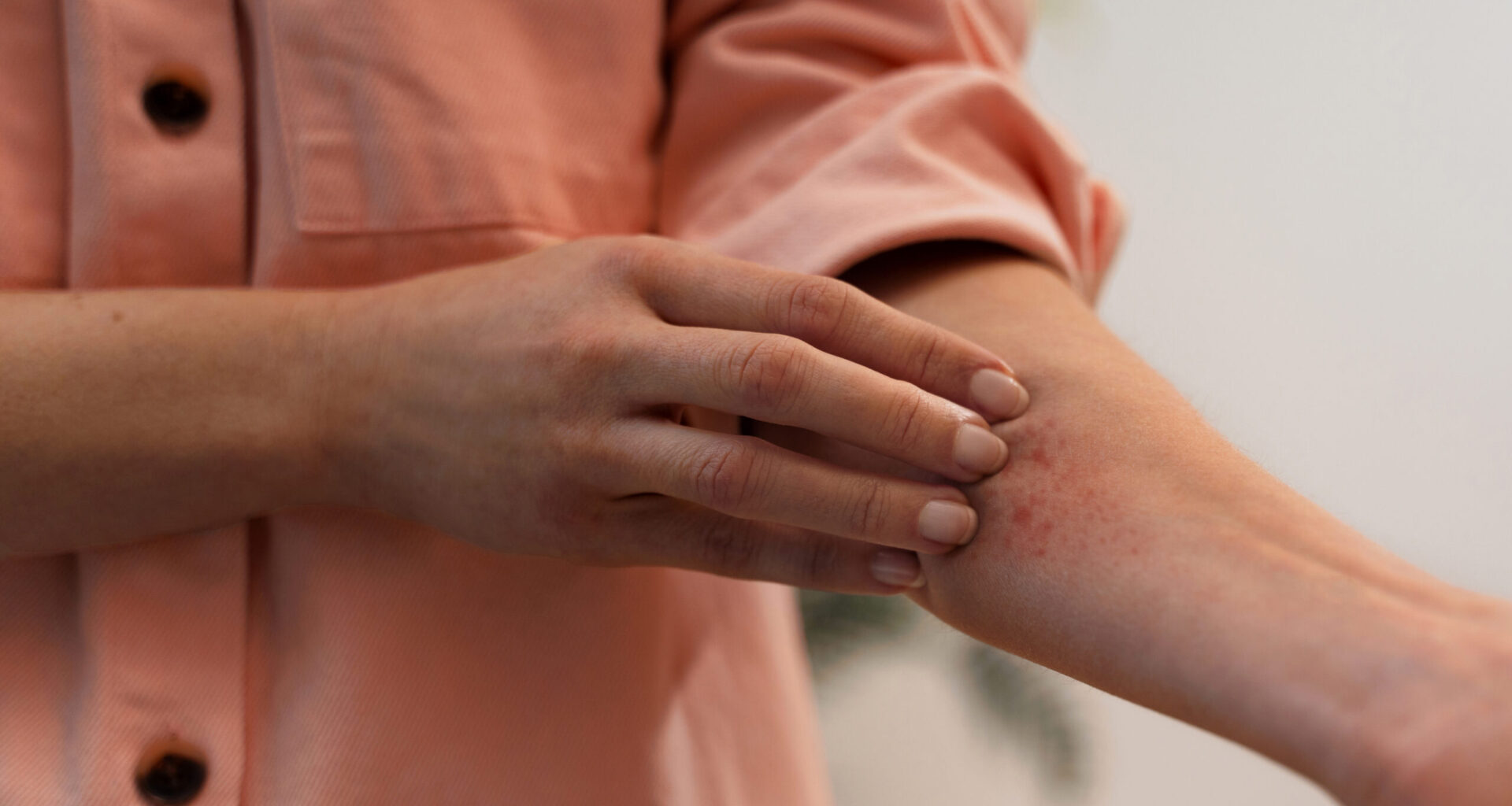 El diagnóstico precoz, esencial en el abordaje de la dermatitis atópica, que afecta hasta un 25% de niños y entre el 3 y el 7% de adultos