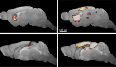 Revelan alteraciones cerebrales tempranas vinculadas al riesgo de depresión en párkinson