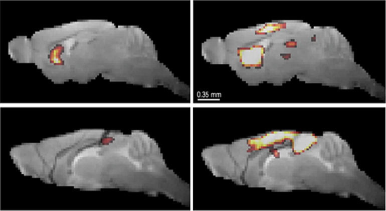 Revelan alteraciones cerebrales tempranas vinculadas al riesgo de depresión en párkinson