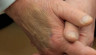 Por qué el visible hematoma en la mano de Donald Trump puede ser el síntoma de algo más grave, según una cirujana vascular