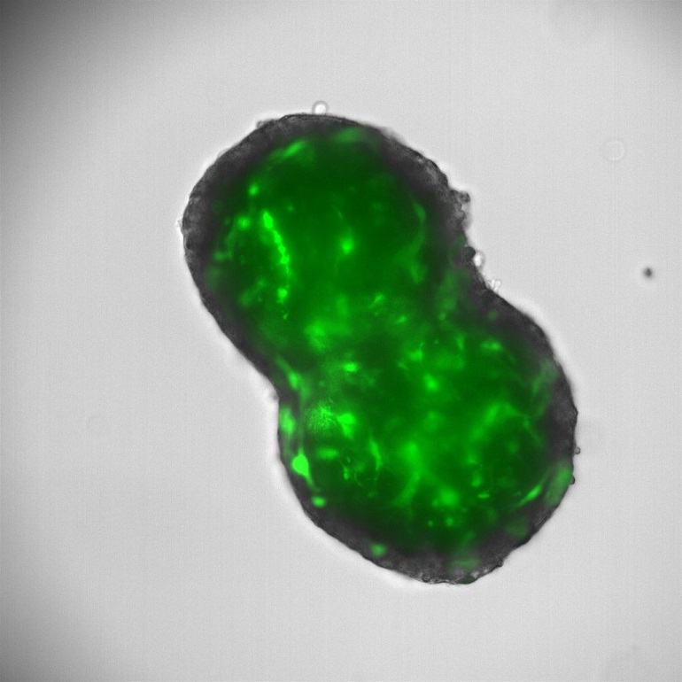 Nueva diana terapeútica para bloquear el avance de un cáncer de hígado muy agresivo