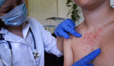 se detecta un brote de sarampión en una familia antivacunas de Cataluña y podría haber más de 300 contactos