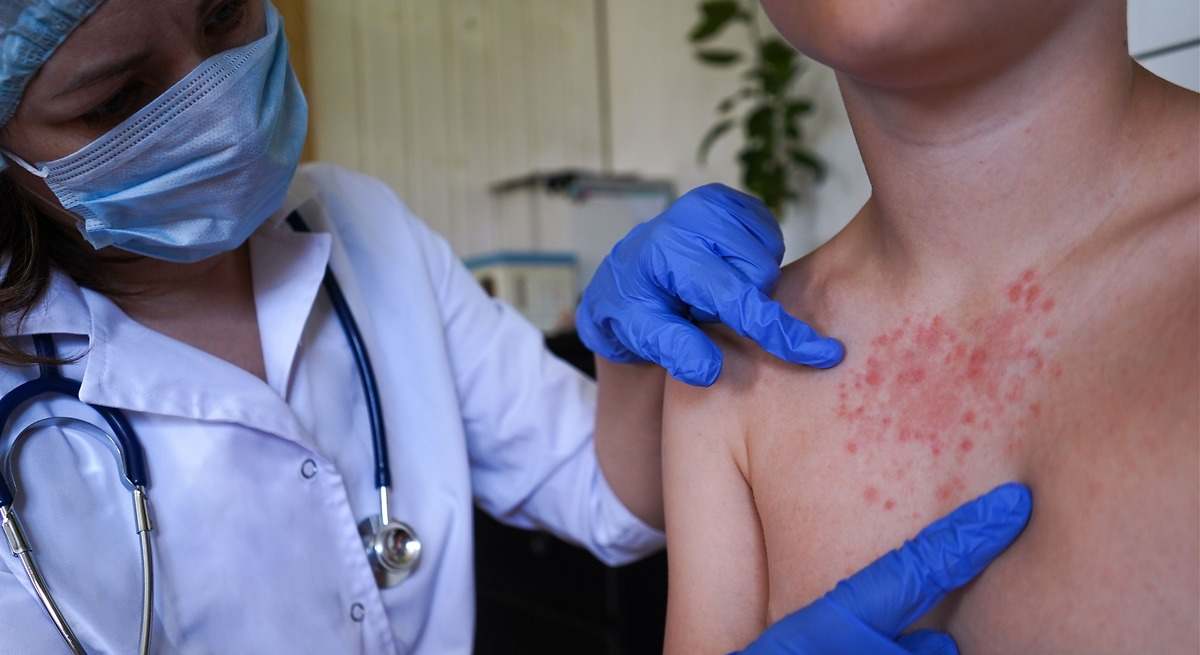 se detecta un brote de sarampión en una familia antivacunas de Cataluña y podría haber más de 300 contactos