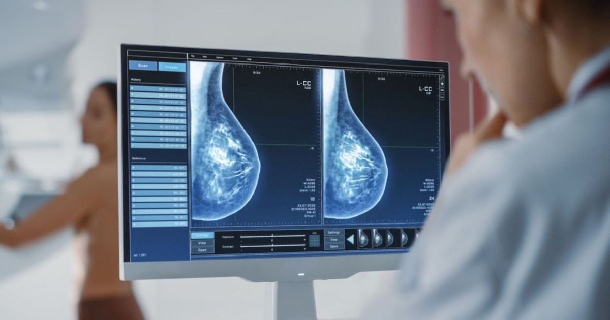 Cómo la secuenciación del genoma permite personalizar el tratamiento del cáncer de mama