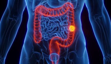 Advierten por un factor de riesgo de cáncer de colon en jóvenes que suele subestimarse