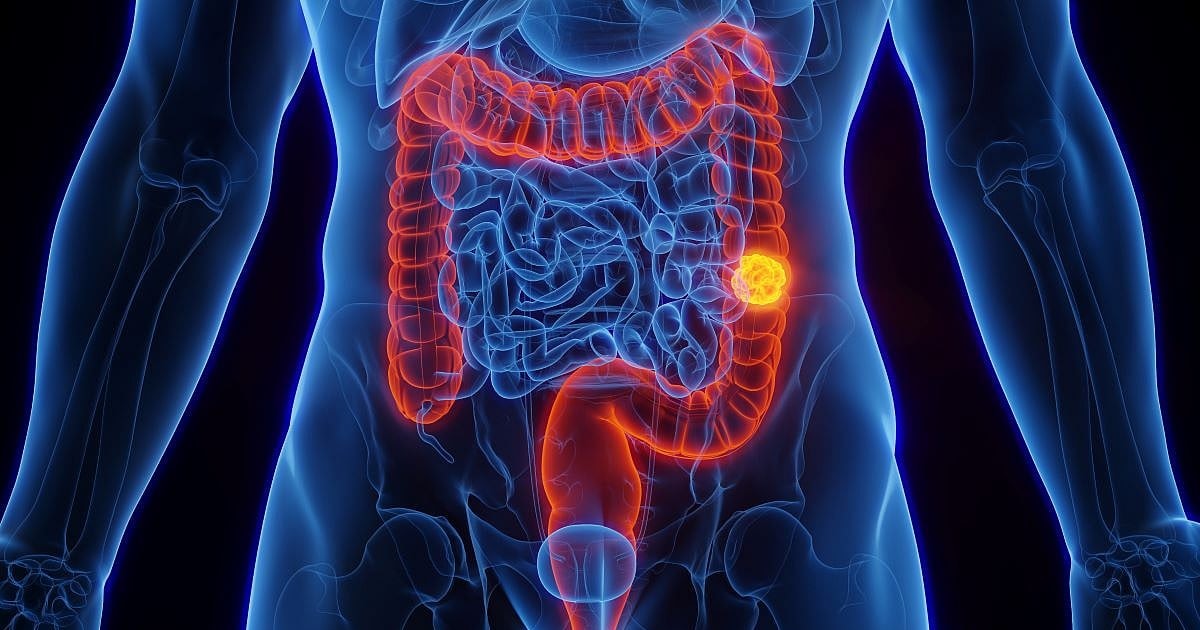 Advierten por un factor de riesgo de cáncer de colon en jóvenes que suele subestimarse