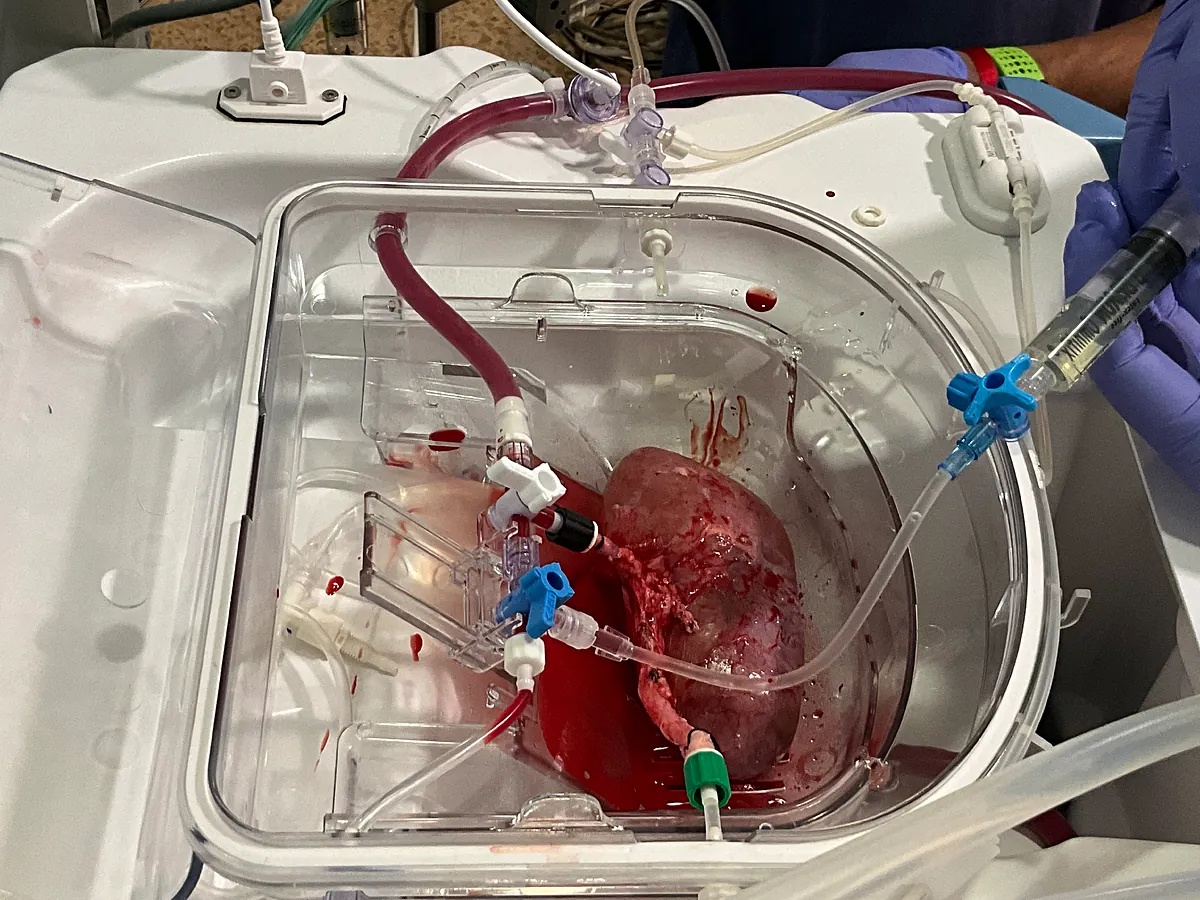 Primer trasplante de riñones modificados con organoides renales humanos en cerdos - El Mundo