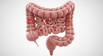 El 88% de los diagnosticados