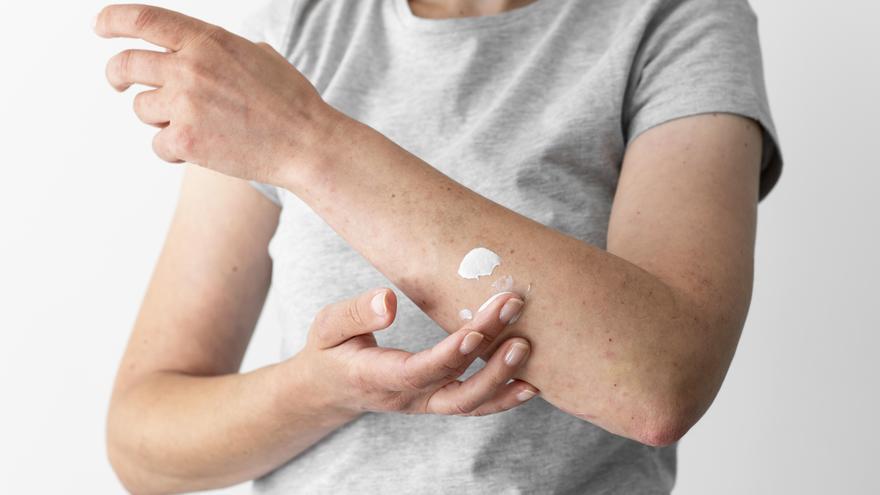 Dermatitis atópica: ¿se puede frenar el curso de la enfermedad?
