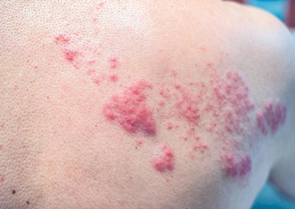 Ampollas en el torso producidas por el virus del herpes zóster.