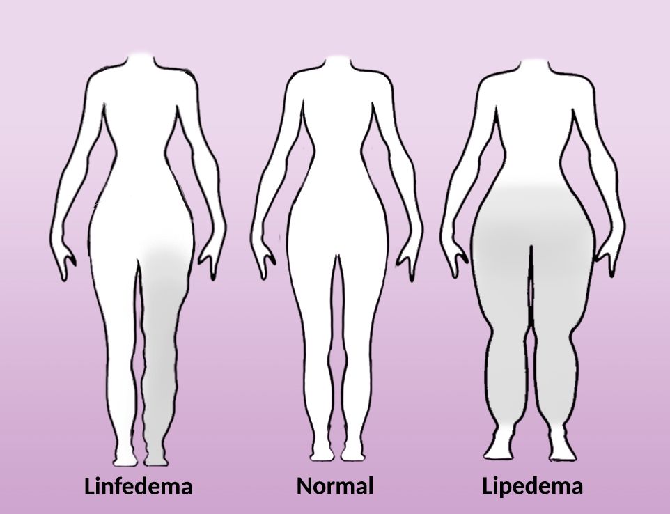 Lipedema y linfedema, dos enfermedades con síntomas parecidos, pero tratamientos distintos | Líder en Información Social