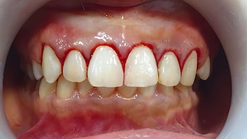 Las enfermedades periodontales aumentan el