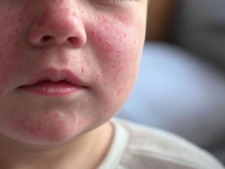 Brote de sarampión se expande en Estados Unidos; reportan caída de tasas de vacunación 