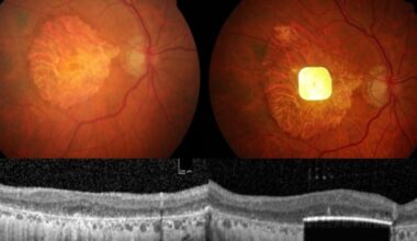 Un chip implantado en el ojo permite que 27 personas ciegas vuelvan a leer