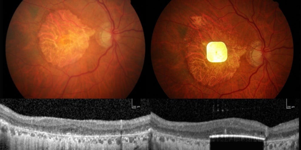 Un chip implantado en el ojo permite que 27 personas ciegas vuelvan a leer