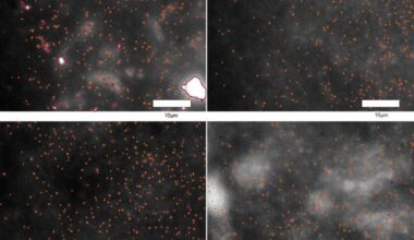 Observan por primera vez las ‘primeras huellas’ del párkinson en tejido cerebral