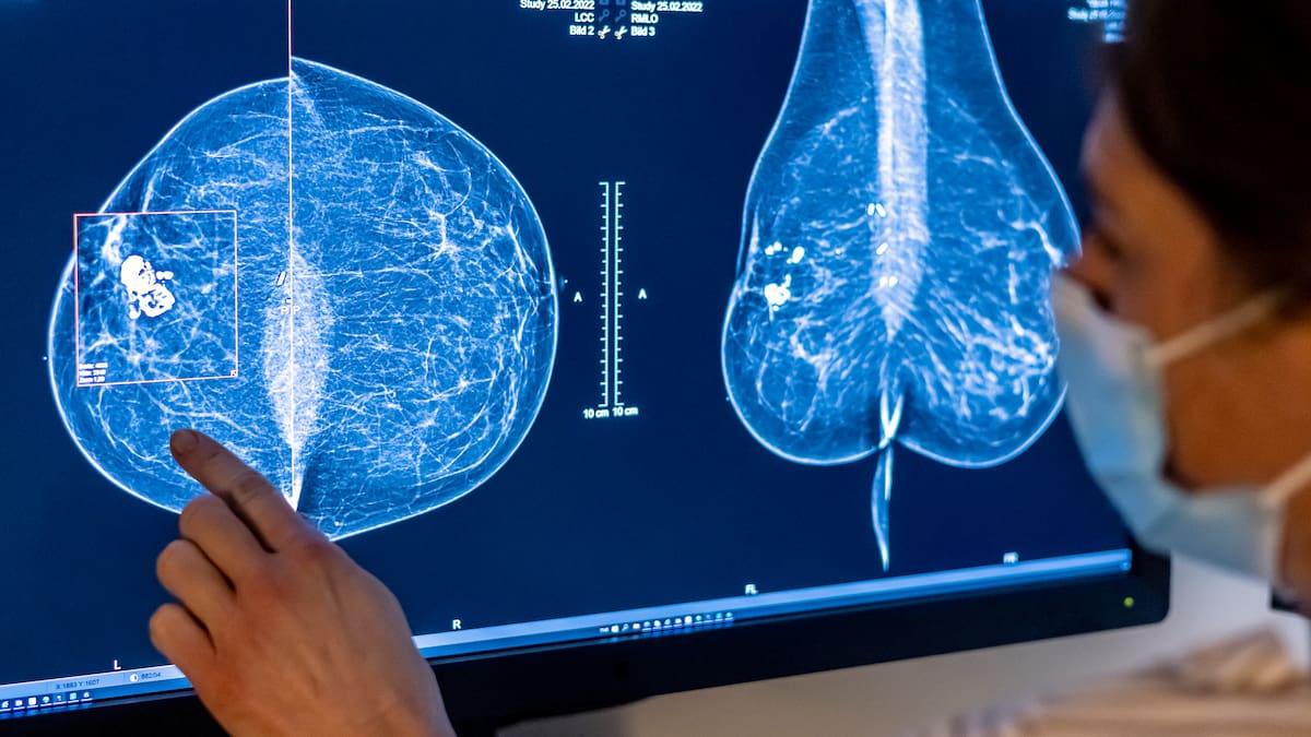 Otra mujer denuncia que las imágenes y el informe tras una mamografía en Sevilla han cambiado: ya no hay marcas y su documento no está firmado por ningún médico | Radio Sevilla