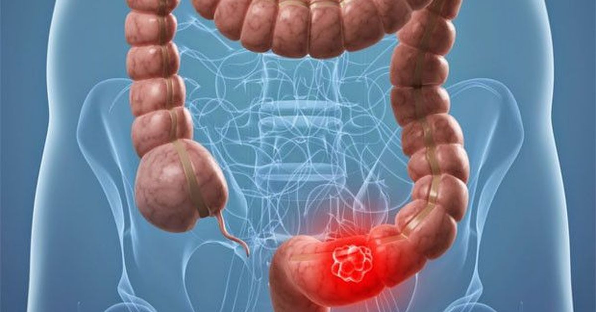 El sangrado rectal en menores de 50 Años dispara 8,5 veces el riesgo de cáncer colorrectal, según un estudio