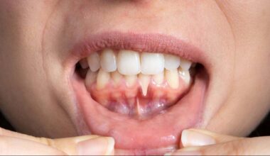 Los médicos piden que prestemos atención al sangrado de encías y las caries: "Tienen casi el doble de riesgo de sufrir un accidente cerebrobascular"