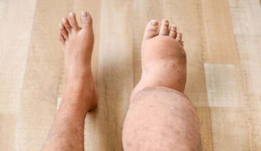 "La hinchazón repentina de una pierna o un brazo es un síntoma claro de esta enfermedad mortal"