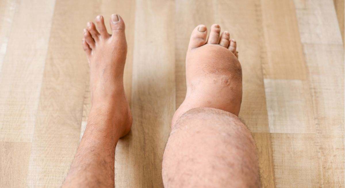 "La hinchazón repentina de una pierna o un brazo es un síntoma claro de esta enfermedad mortal"