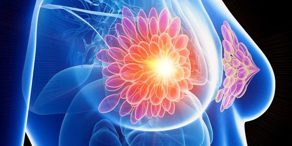 Así beneficia la secuenciar el genoma completo a las mujeres con cáncer de mama