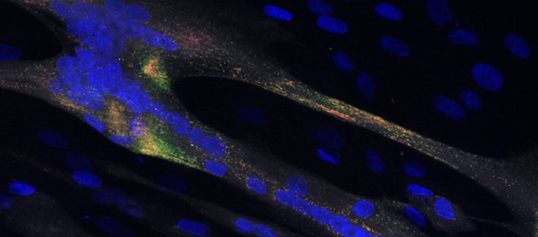 Descubren un nuevo gen causante de una miopatía congénita